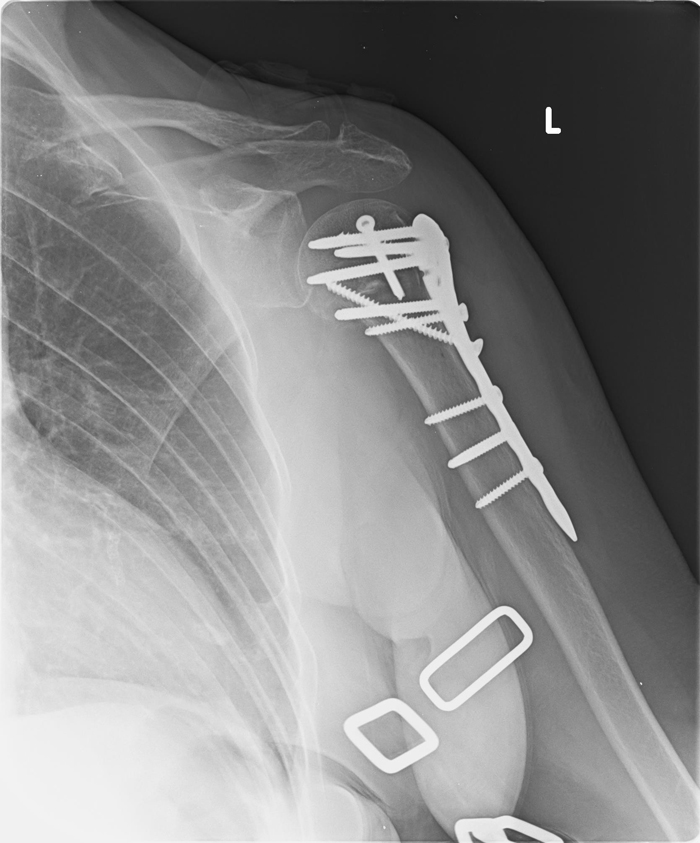 Humerus-fracture-after