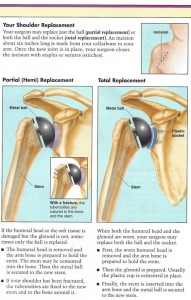 Shoulder-Replacement-Basics | Dr. John Skedros