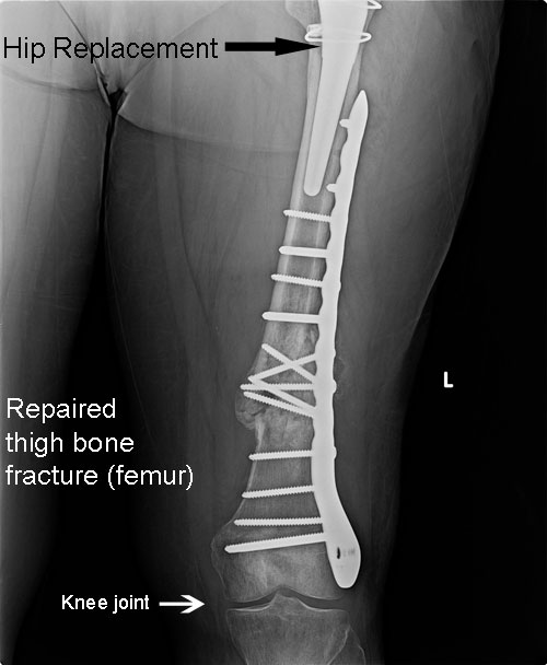 Hip & Ankle Fracture Repair Dr Skedros Orthopaedics