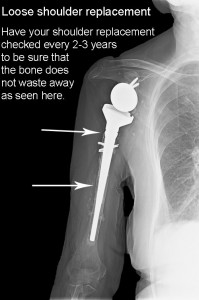 Loose-shoulder-replacement – Dr. John Skedros