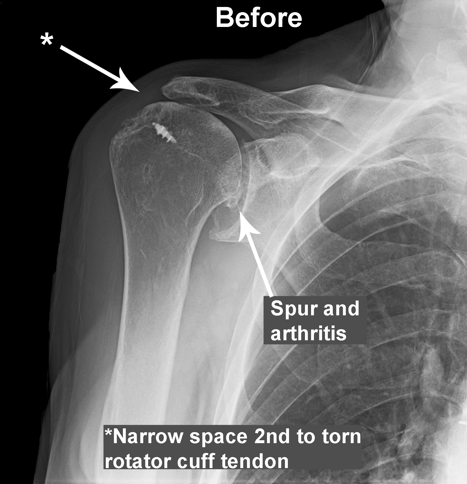 Partial or Total Shoulder Replacement | Dr Skedros Orthopaedics