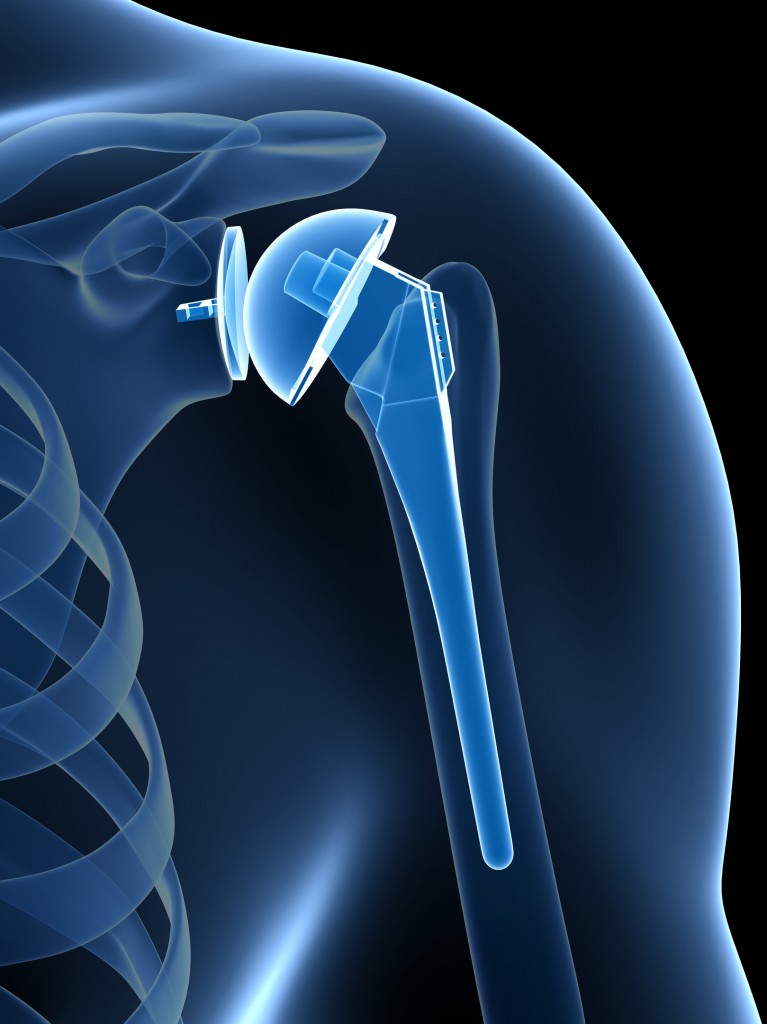 Shoulder Replacement – Dr. John Skedros